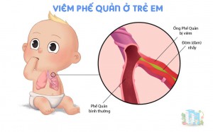 Viêm Phế Quản Ở Trẻ Em | Cốm Bảo Khí Nhi Plus từ Cỏ Xạ Hương