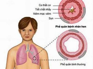 Tìm hiểu về bệnh ho hen – hen phế quản – hen suyễn ở trẻ em