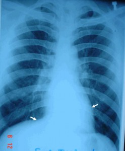 Những điều cần biết về chụp X-Quang viêm phế quản ở trẻ em